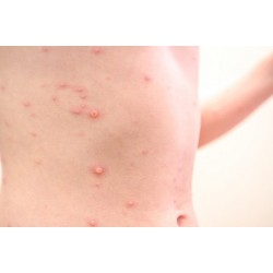 Sociedades médicas alertam sobre cuidados com a varíola dos macacos